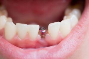 es doloroso un implante dental