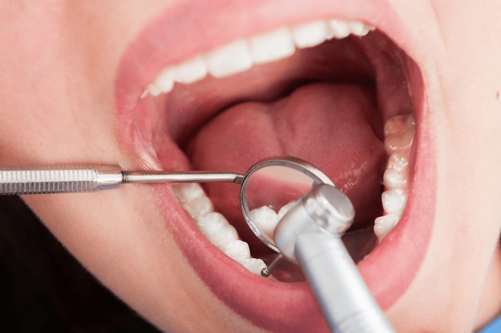 tratamiento endodoncia jaén