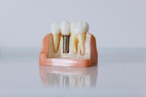 cuanto tiempo dura el proceso de un implante dental
