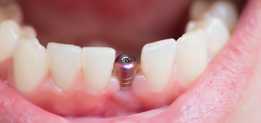 es doloroso un implante dental