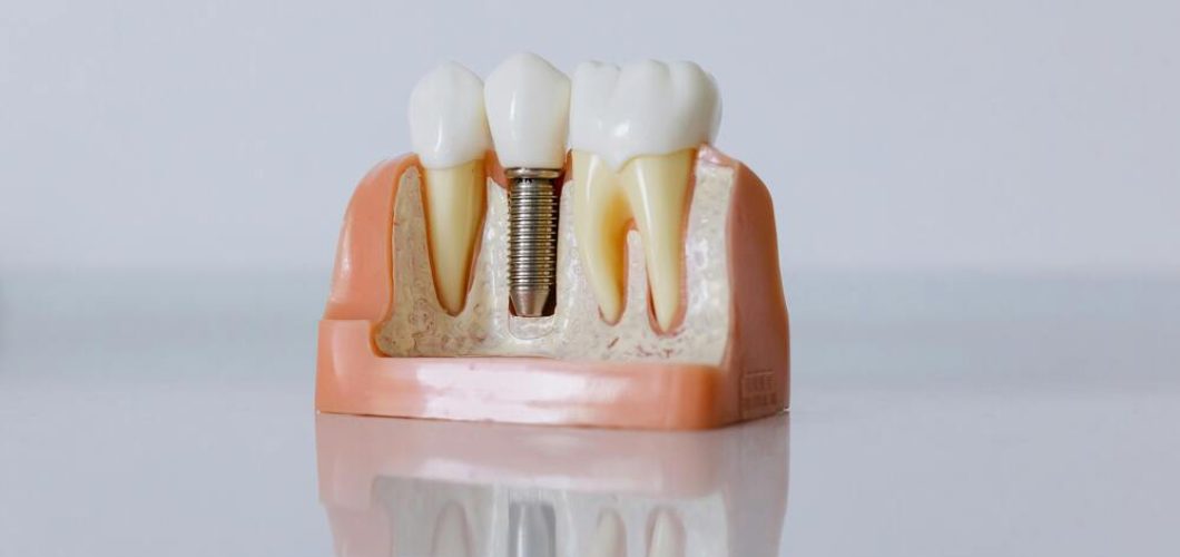 cuanto tiempo dura el proceso de un implante dental