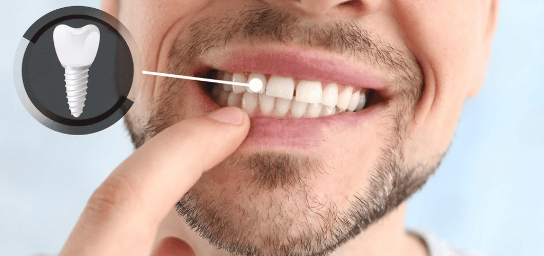 merece la pena ponerse un implante dental