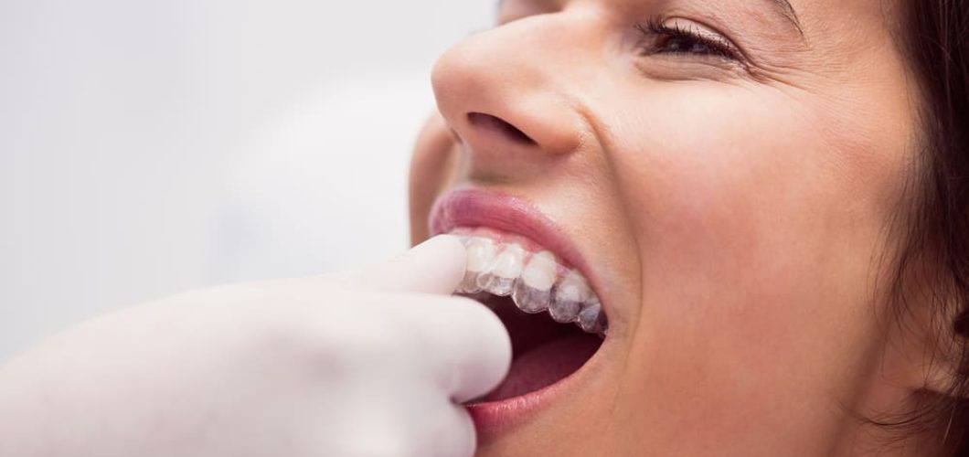 para que sirven los ataches invisalign