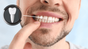 merece la pena ponerse un implante dental