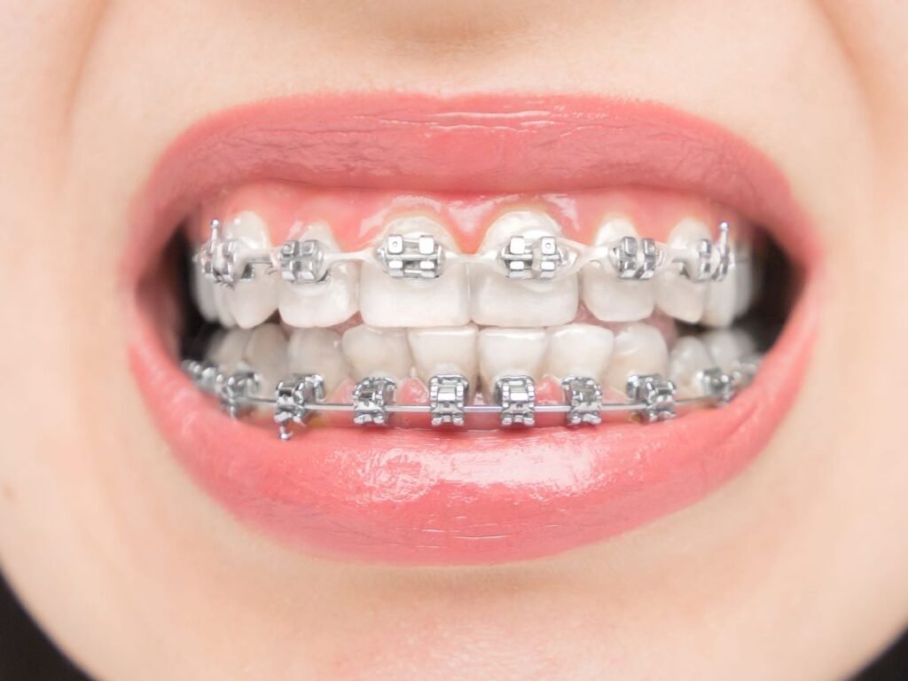 ortodoncia brackets jaen