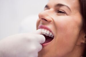 para que sirven los ataches invisalign