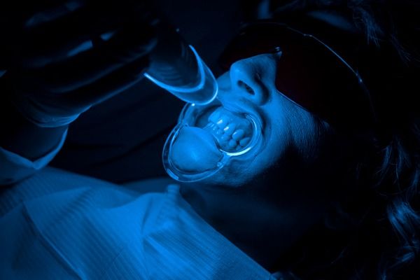 estetica dental jaen carillas dentales