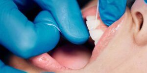 remedios caseros periodontitis